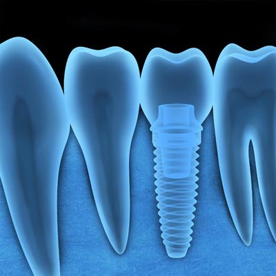 Dental Implants in Delhi