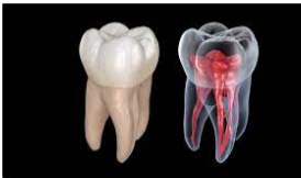 Root Canal Treatment