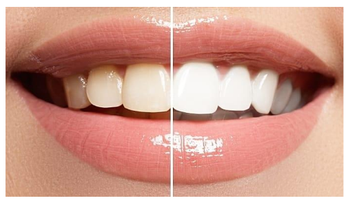 Cost of whitening teeth in India